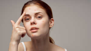 Harsh Acne Treatments