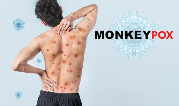 Sign & Symptoms of Monkeypox Virus outbreak and How to Prevent it