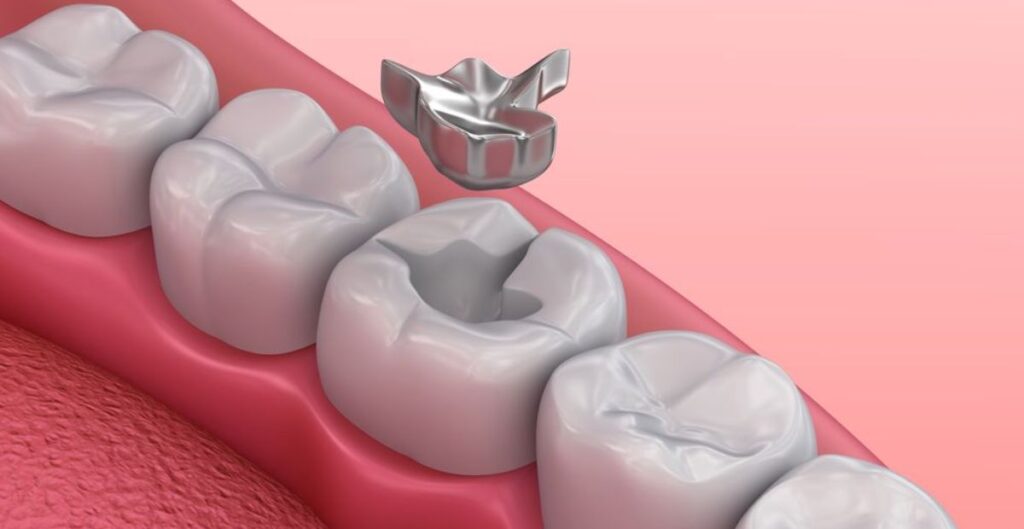 Amalgam Removal