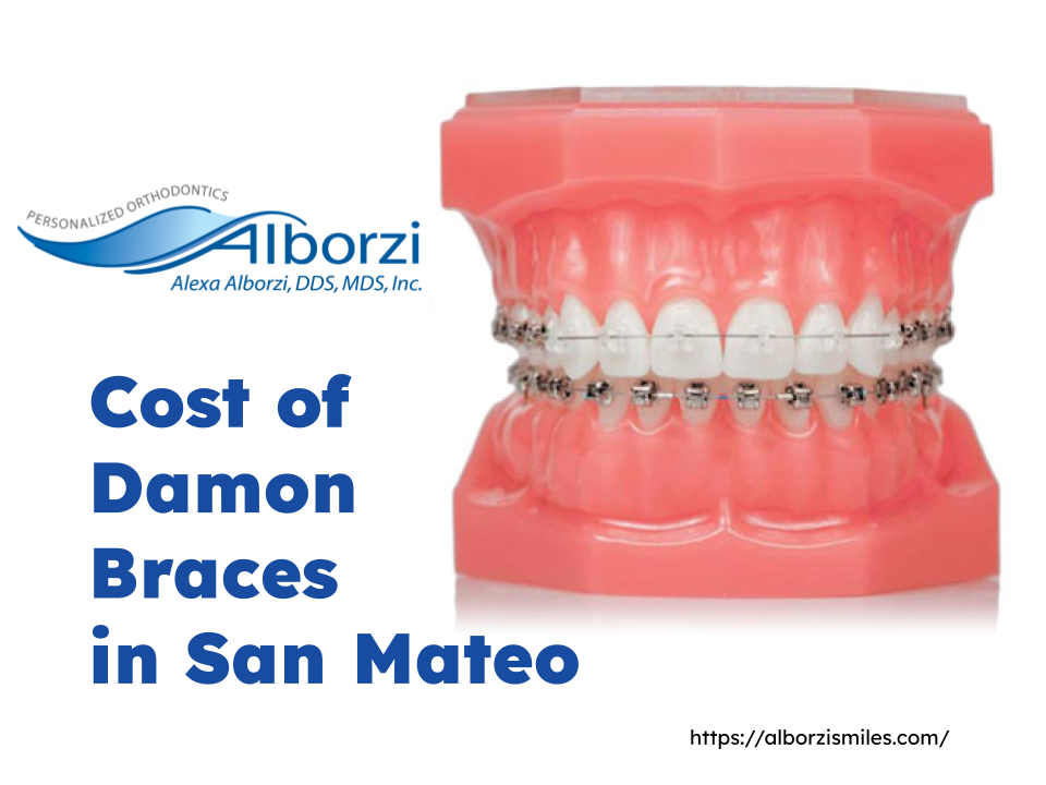 Cost of Damon Braces in San Mateo