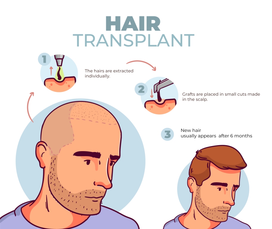 The Importance of Increasing Access to Hair Transplants for African America